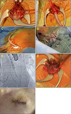 The Transaxillary Approach via Prosthetic Conduit for Transcatheter Aortic Valve Replacement With the New-Generation Balloon-Expandable Valves in Patients With Severe Peripheral Artery Disease